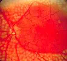 Ochii angiopatie retiniene si tratamentul acesteia