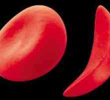 Anizocitoză globule rosii intr-un test de sânge (RDW index)