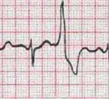 Simptomele de aritmie cardiacă