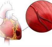 Cardiomiopatie ischemică