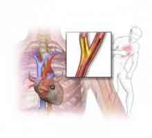 Ischemie miocardică: cauze, simptome, diagnostic, tratament