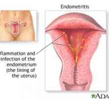 Endometrita - ce fel de infecție și cum să-l trateze?