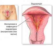 Endometrita și endometrioza - în ton cu numele, dar diferite diagnostice