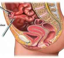 Tratamentul și prevenirea bolilor abdominale adezive