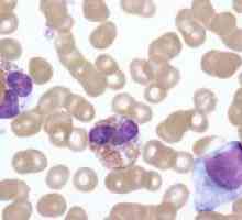 Reacția sângelui Leukemoid