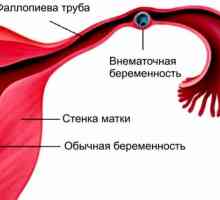 Principalele cauze ale durerii dreapta fata-verso in timpul menstruatiei