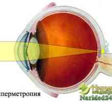 Tratamentul Poporului bolilor de ochi - hipermetropie