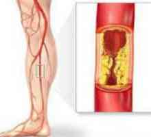 Ateroscleroza navelor ale picioarelor