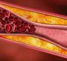 Ocluzia (obstrucția vaselor de sânge) - o manifestare formidabil de insuficienta vasculara