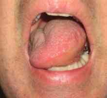 Umflarea gurii, limbii și gâtului