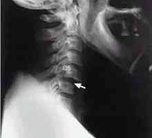 Subluxație de vertebră cervicală
