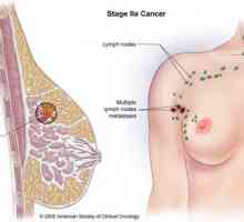Cancer de san (glanda mamară)