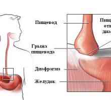 Dezvoltarea și tratamentul herniei al esofagului