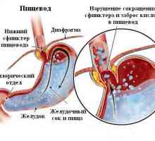 Cauzele si tratamentul disfagie esofagian