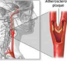 Stenoză a arterelor carotide