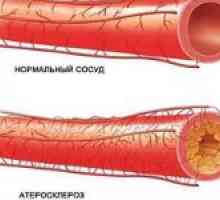 Ateroscleroza constrictiv