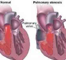 Îngustarea valvei pulmonare