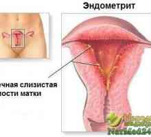 Metode populare unice de ajutor cu endometrita
