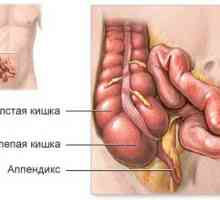 Tipuri de operații de apendicită