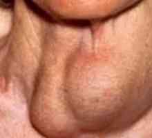 Boli tiroidiene, descoperit in Japonia - Hashimoto