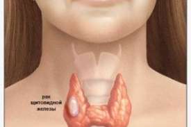 Daca cancerul este periculos tiroidian