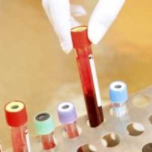 - Sumar de urina leucocite și eritrocite: Transcrierea rezultatelor studiului