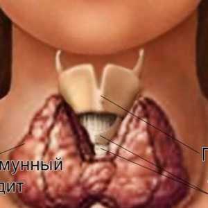 Boli autoimune ale glandei tiroide de sex feminin: semnele de distrugere și tratamentul tiroidita
