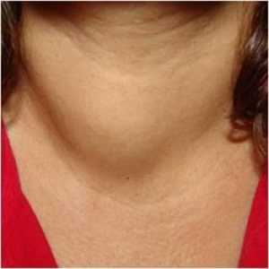 Tiroidita Hashimoto cu rezultatul hipotiroidismului: simptome și tratament