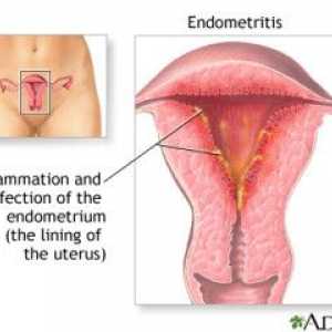 Endometrita - ce fel de infecție și cum să-l trateze?