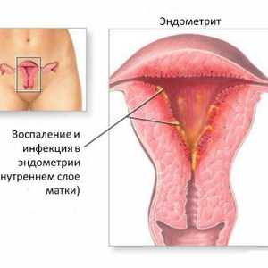 Endometrita și endometrioza - în ton cu numele, dar diferite diagnostice