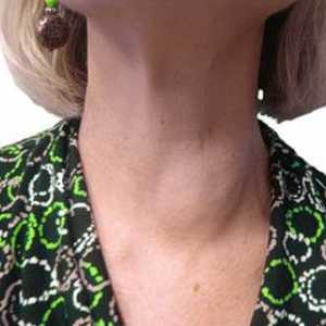 Cum de a trata noduli tiroidieni