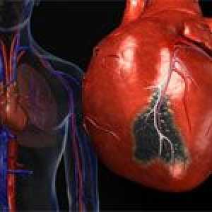 Infarct miocardic și tratamentul său