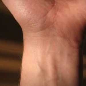 Tratamentul osteoartritei articulației încheietura mâinii