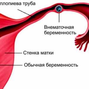 Principalele cauze ale durerii dreapta fata-verso in timpul menstruatiei