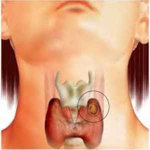 Caracteristici de tratament de chisturi tiroidiene
