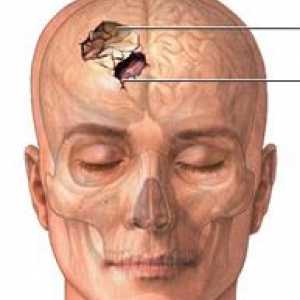 Fractură craniană