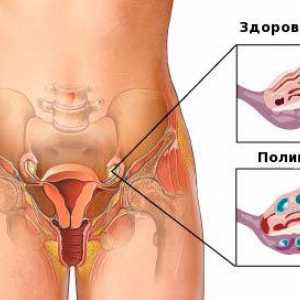 Sindromul ovarului polichistic si sarcina