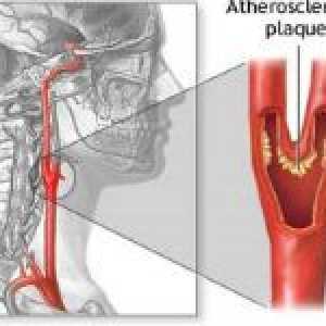 Stenoză a arterelor carotide