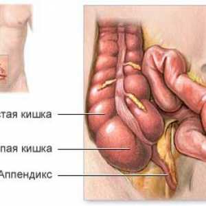 Tipuri de operații de apendicită
