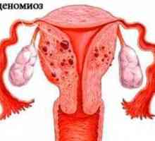 Adenomioza si endometrioza: cum să se facă distincția între aceste boli?