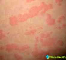Urticarie alergice: consiliere, tratament și prevenire