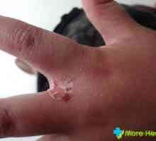 Alergică la pielea mâinilor: simptome și tratament
