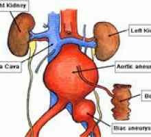 Anevrism aortic abdominal si tratamentul acesteia