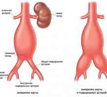 Anevrism aortic abdominal, ca urmare a aterosclerozei