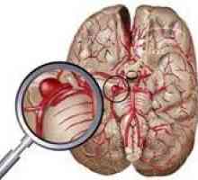 Principalele simptome de anevrism cerebral