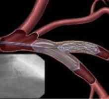 Angioplastia in tratamentul leziunilor vasculare