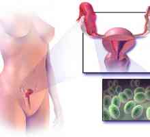 Apoplexie ovarian: patologie vasculară