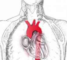 Takayasu Arterita (aortoarteriit nespecifice): simptome, diagnostic, terapie