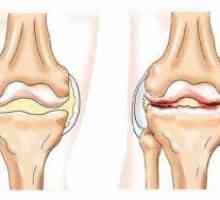Osteoartrita: remedii populare Tratamentul