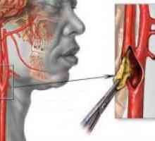 Modificări de aterom ale arterelor carotide